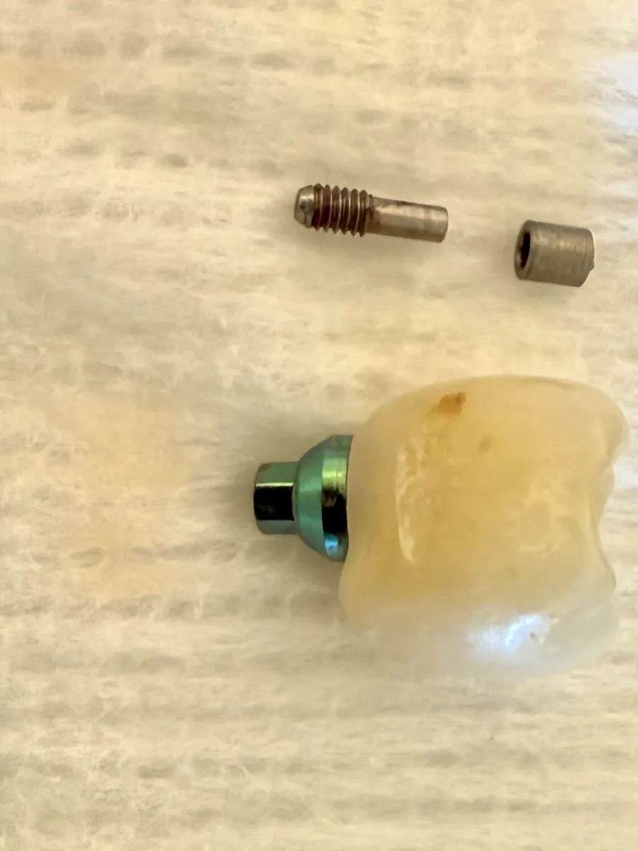 Fractured implant abutment screw retrieved in two pieces, with the original implant crown and attached abutment