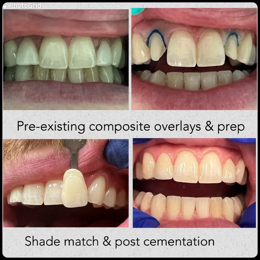 Veneers case