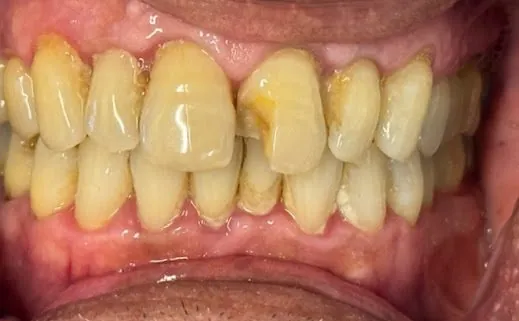 Before cosmetic dental treatment at Deccan Dental, San Mateo