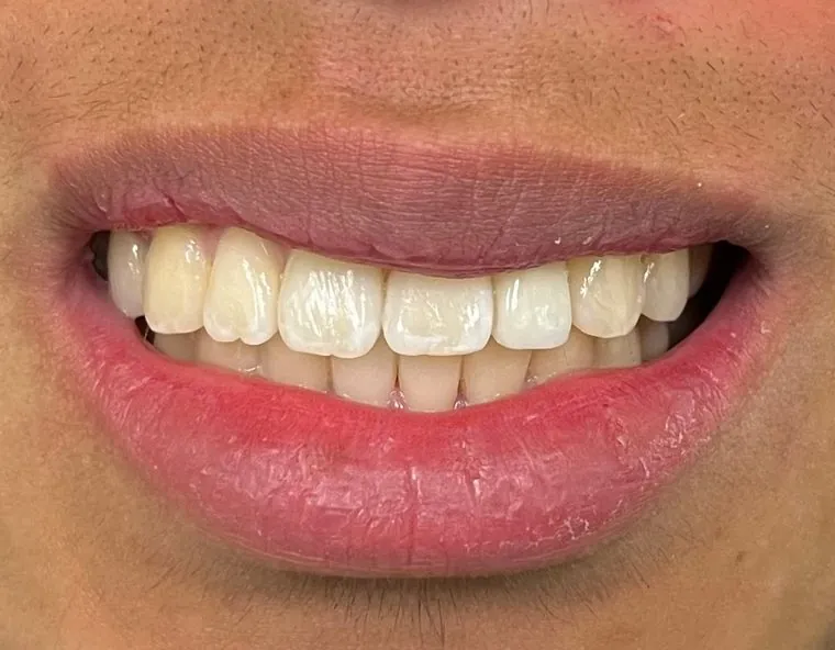 After Dental Implant