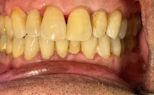After cosmetic dental treatment at Deccan Dental, San Mateo