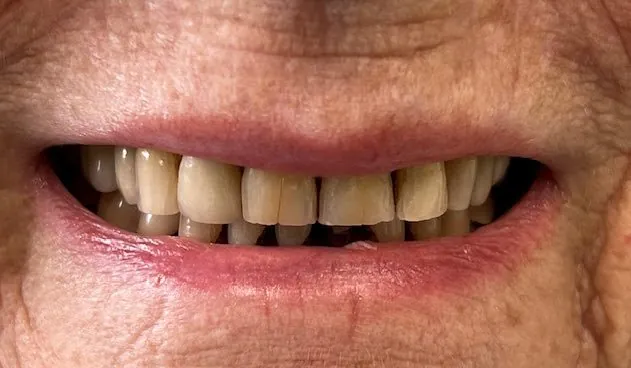 Before Full-Mouth Restoration