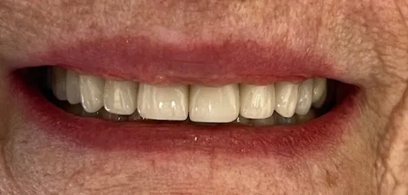 After Full-Mouth Restoration
