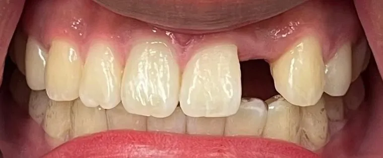 Before Dental Implant